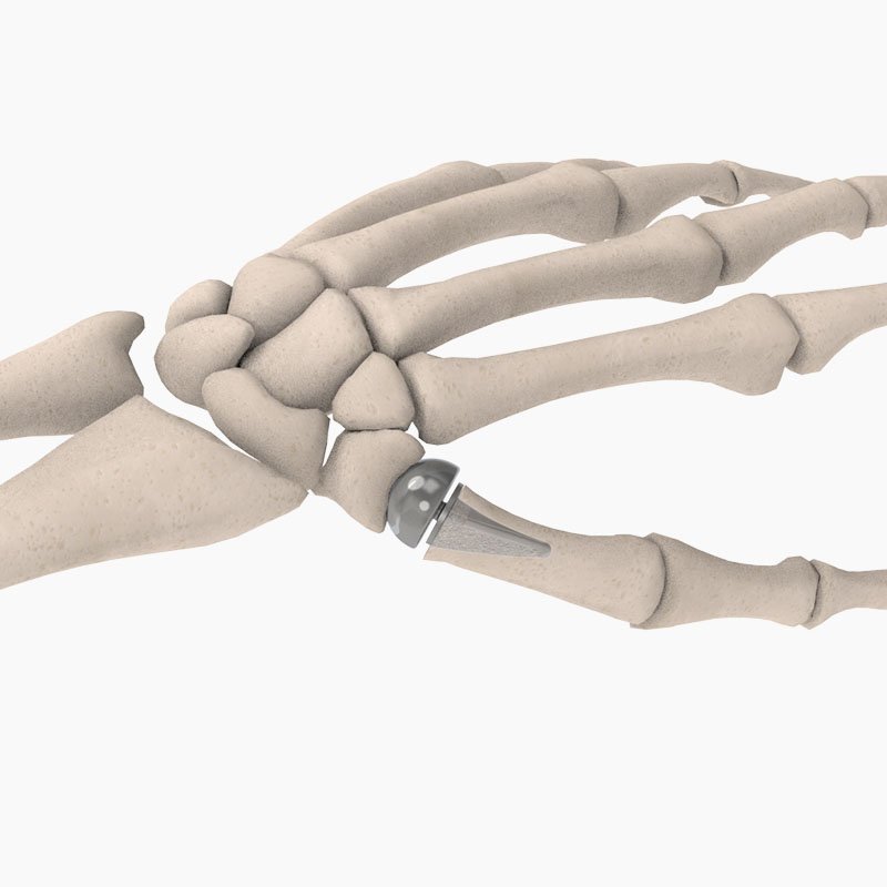 Joint Replacement Implants